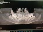 Боль после лечения 6ки и удаления зуба мудрости фото 1