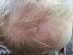 Красные пятна у ребёнка на волосистой части головы фото 5