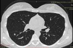 Мелкие очаги в лёгких после рака фото 2