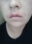 Жжение после депиляции на верхней части губы фото 2