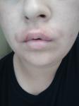 Жжение после депиляции на верхней части губы фото 1