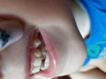 Коричневый налёт и ямочки на зубках у ребёнка в 3 года фото 3