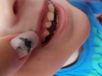 Коричневый налёт и ямочки на зубках у ребёнка в 3 года фото 1