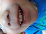 Коричневый налёт и ямочки на зубках у ребёнка в 3 года фото 2