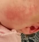 Аллергия или цветение у новорождённого фото 1