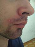 Покраснение вокруг носа, рта - зуд, шелушение фото 1
