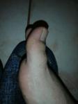 Пигментная полоса на пальце ноги фото 2