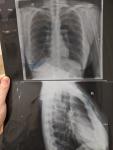Возможна ли ложная пневмония по рентгену фото 1