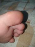 Белая точка на пальце ноги фото 1