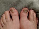 Темные пятна на ногтях больших пальцев ног фото 1