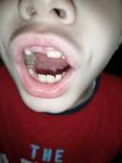 Зубы меняются не по порядку у ребенка в 6 лет фото 1