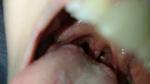 Белый нарост на миндалинах без боли в горле фото 1