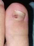 Темное пятно на ногте большого пальца ноги фото 1