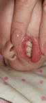 Как лечить зубы грудному ребёнку? фото 1