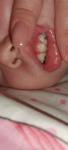 Как лечить зубы грудному ребёнку? фото 2