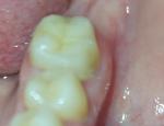 Болит зуб без нерва фото 2