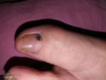 Потемнение ногтя на большом пальце ноги фото 2