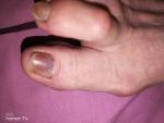 Потемнение ногтя на большом пальце ноги фото 1