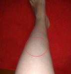 Отёк и белое пятно на ноге после травмы фото 1