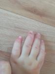 Волдыри на пальцах у ребёнка фото 2