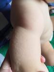 Мелкая сыпь у ребёнка на ручках и на ножках фото 1