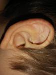 Красные пятна на мочке уха фото 1