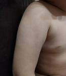 Бесцветная сыпь у ребенка 3 лет фото 1