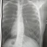 Подозрение на воспаление лёгких, фото рентгена фото 3