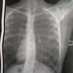 Подозрение на воспаление лёгких, фото рентгена фото 2