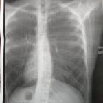 Подозрение на воспаление лёгких, фото рентгена фото 1