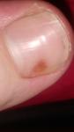 Красное пятно на ногте большого пальца правой ноги фото 1