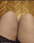 Зудящая сыпь на ногах (а впоследствии и на руках, спине) фото 1