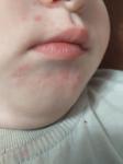 Сыпь у ребенка под носом, глазами и на подбородке фото 1
