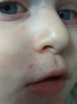 Сыпь у ребенка под носом, глазами и на подбородке фото 2