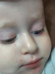 Сыпь у ребенка под носом, глазами и на подбородке фото 3