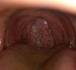 Инфекция в горле, обследования и лечение фото 2