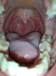 Боль, маленькие белые точки в горле и длительный субфебрилитет фото 2