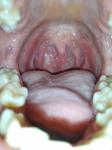 Боль, маленькие белые точки в горле и длительный субфебрилитет фото 1