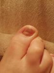 Потемнение ногтя на большом пальце ноги фото 1