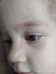 Сыпь в верхней части носа у ребенка 2 лет фото 1