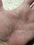 Трещины на лодошках и пальцах рук глубокие ранки с шелушеним фото 4