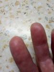 Трещины на лодошках и пальцах рук глубокие ранки с шелушеним фото 3