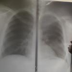 Рентген лёгких фото 1