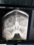 Описание рентгена придаточных пазух носа фото 2