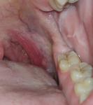 Папилломы на слизистой рта фото 2