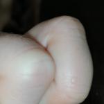 Небольшой волдырь с жидкостью на пальце руки фото 1