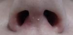 Красные пятна в области ноздрей фото 2