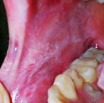 Отечность слизистой полости рта фото 1