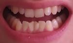 Почему стачиваются зубы? фото 1