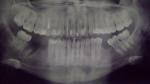 Воспаление после удаления зуба фото 1